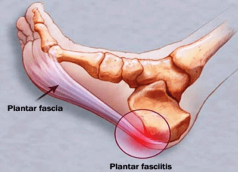 Fascitis plantar
