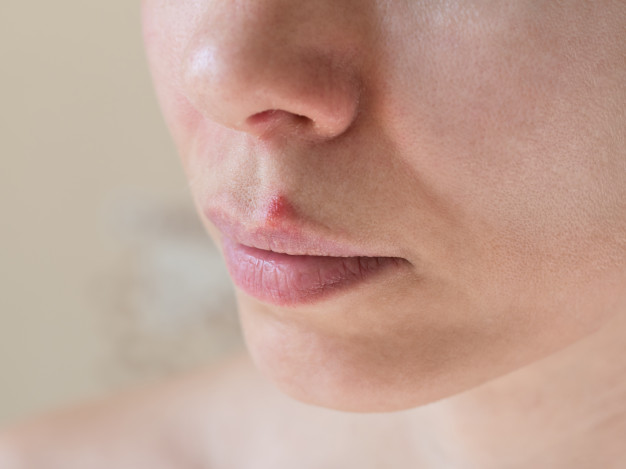 chica con herpes bucal sobre el labio